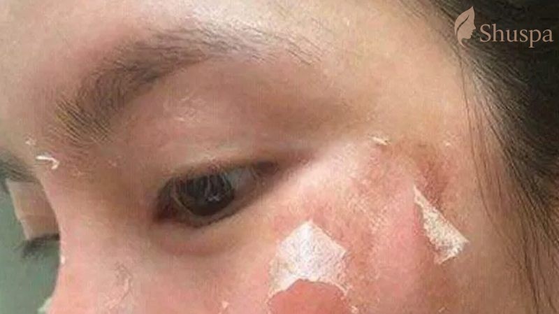 Đối với quá trình lão hóa peel da có những tác động tích cực