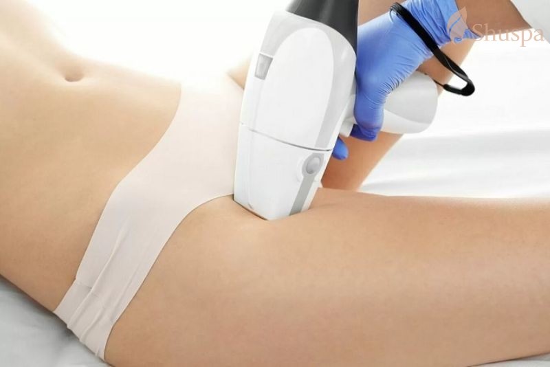 Ứng dụng phương pháp laser để triệt lông vùng bikini
