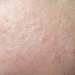 Mụn nhỏ liti trên mặt được hình thành do tế bào da chết không được loại bỏ hoàn toàn