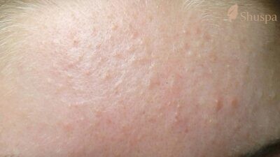 Mụn nhỏ liti trên mặt được hình thành do tế bào da chết không được loại bỏ hoàn toàn