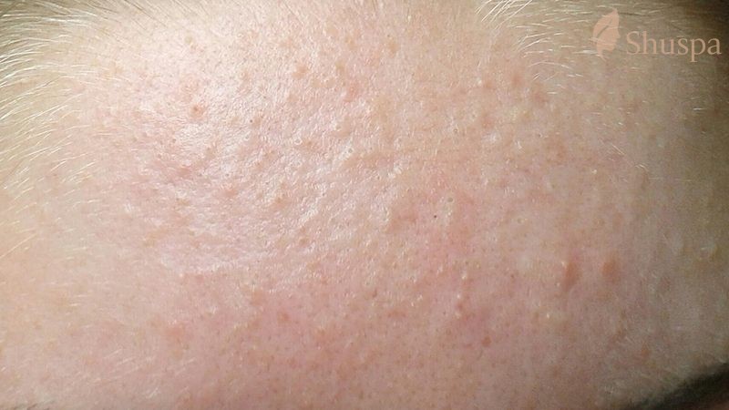Mụn nhỏ liti trên mặt được hình thành do tế bào da chết không được loại bỏ hoàn toàn