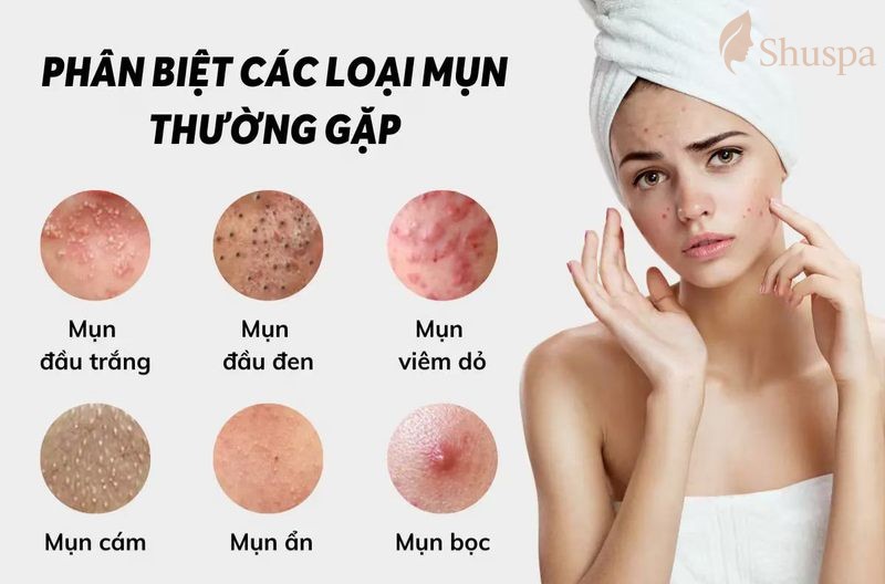 Cần xác định rõ mình đang bị loại mụn viêm nào để có thể chữa trị phù hợp