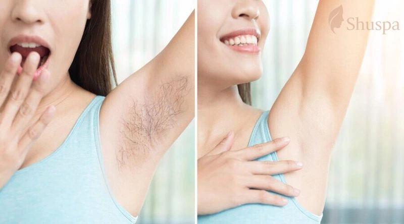 Có thể triệt lông nách tại nhà bằng một số nguyên liệu đến từ thiên nhiên