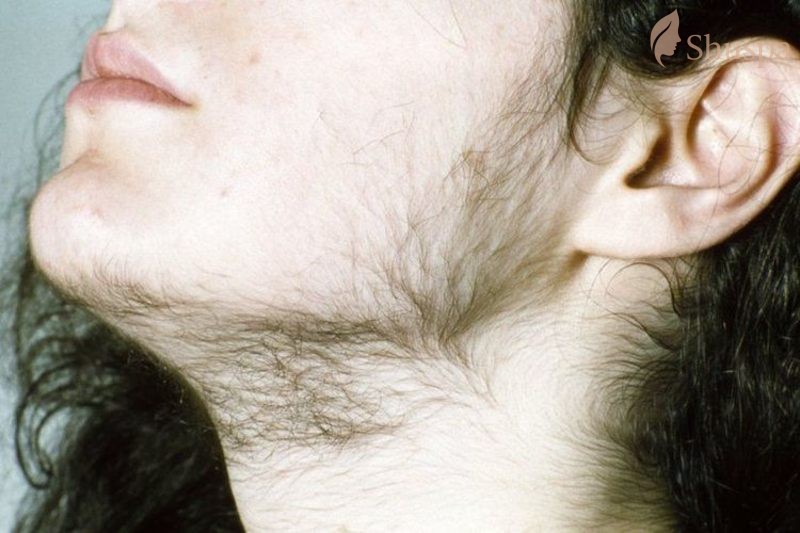 Người bị lông mặt rậm do nội tiết tố hoặc di chuyền nên cân nhắc việc triệt lông mặt