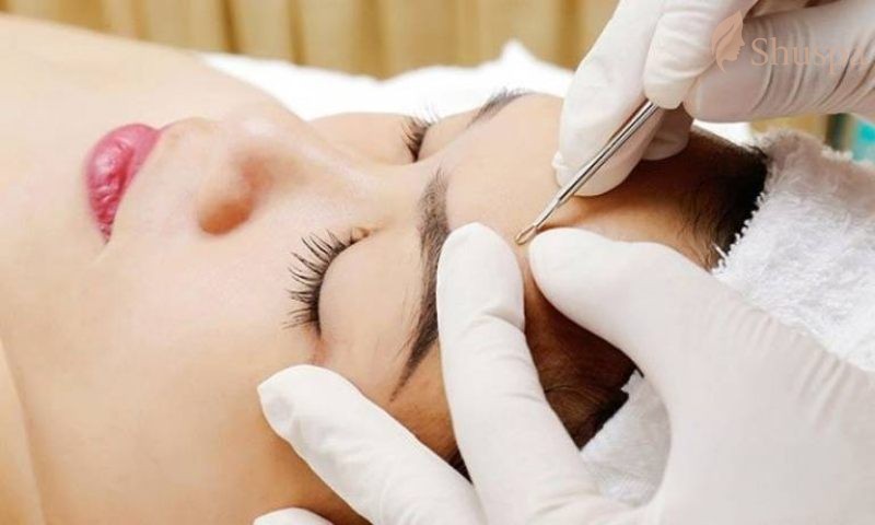 Phương pháp lấy nhân mụn chuẩn y khoa bằng thủ công