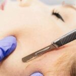 Cạo lông mặt là phương pháp truyền thống được sử dụng nhiều