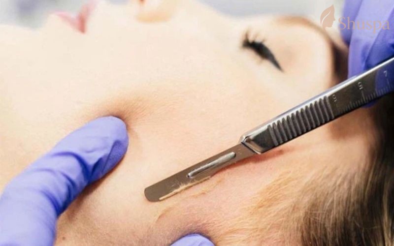 Cạo lông mặt là phương pháp truyền thống được sử dụng nhiều