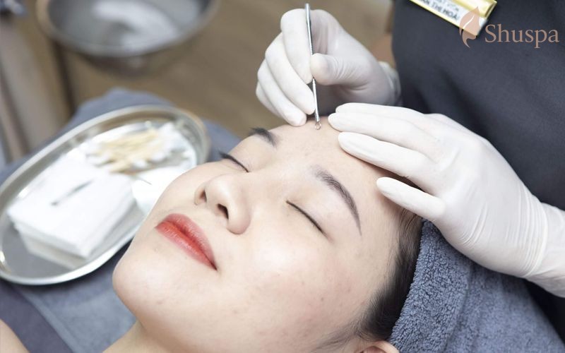 Lấy nhân mụn chuẩn y khoa cần tuân thủ quy trình các bước phù hợp