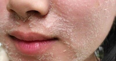 Peel da là làm gì? Đây là quá trình loại bỏ tế bào chết và tái tạo lại làn da