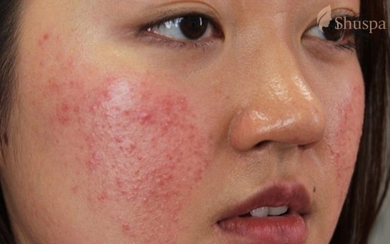 Có thể một số bệnh da liễu là nguyên nhân nhân chính dẫn đến hiện tượng mụn nhỏ liti trên mặt