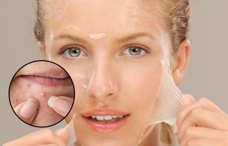 Cần nắm được tình trạng da mặt hiện tại để quyết định có nên peel da không