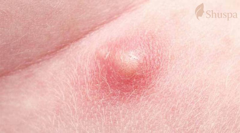 Mụn bọc bị chai cứng là gì? Cách nặn mụn bọc chai cứng hiệu quả nhất