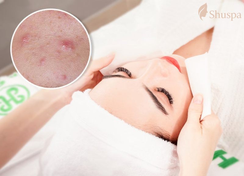 Các phương pháp chăm sóc da sau nặn mụn hiệu quả nhất