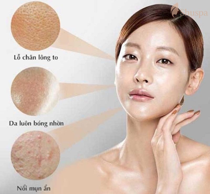 Đối với làn da dầu mụn cần có sản phẩm kem chống nắng phù hợp