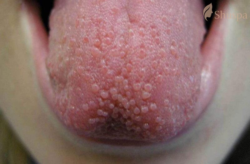 Các loại mụn ở lưỡi phổ biến mà mọi người cần chú ý