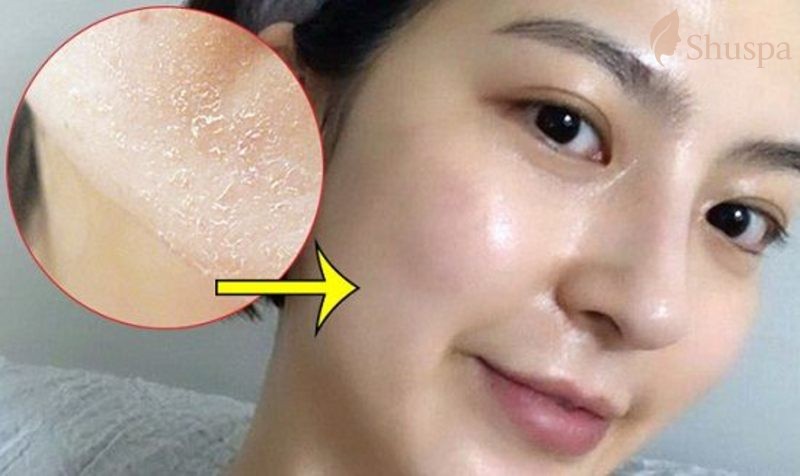 Với những trường hợp đặc biệt phải có những phương pháp peel phù hợp