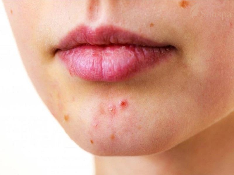 Lối sống và chế độ dinh dưỡng phù hợp sẽ giúp ngăn ngừa mụn bọc 