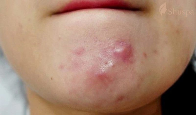 Yếu tố nội tiết tố và hormone là một trong những nguyên nhân hình thành mụn bọc chai cứng