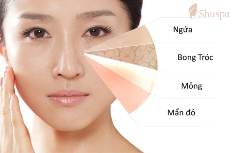 Đối với làn da dầu mụn nếu sử dụng kem chống nắng thường sẽ gây ra nhiều tình trạng xấu