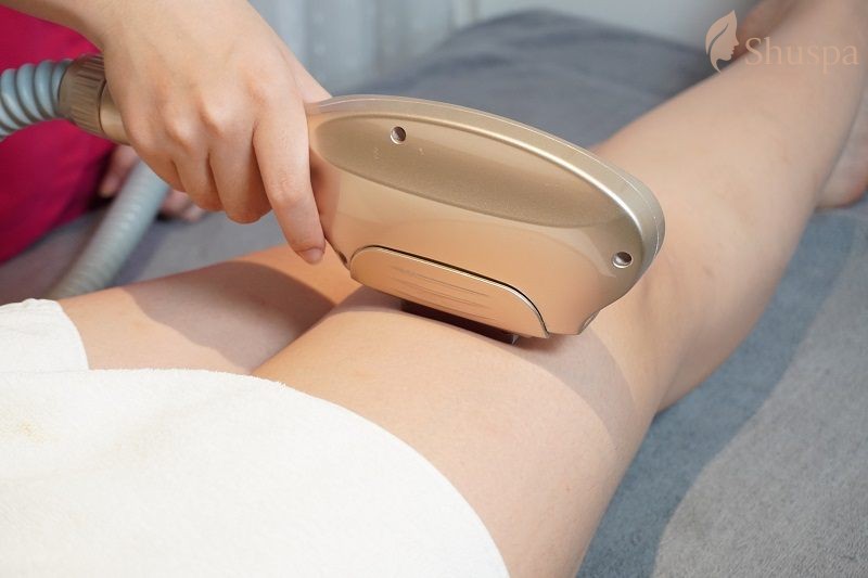 Triệt lông bằng công nghệ E-Light mang lại hiệu quả triệt lông cao hơn 