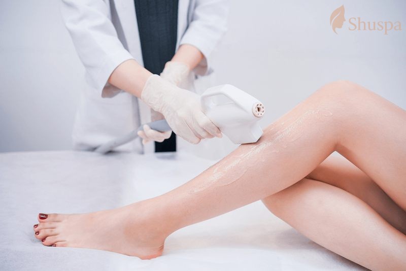 Ưu điểm của triệt lông diode laser là hiệu quả cao và lâu dài