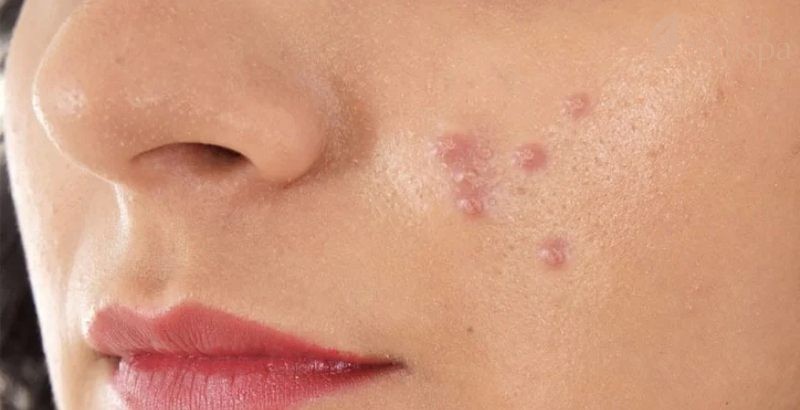 Tuỳ vào mức độ của mụn bọc chai cứng mới nên quyết định nặn mụn hay không?