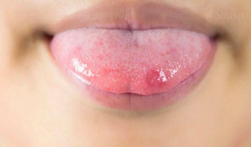 Có nhiều nguyên nhân dẫn đến mụn ở lưỡi