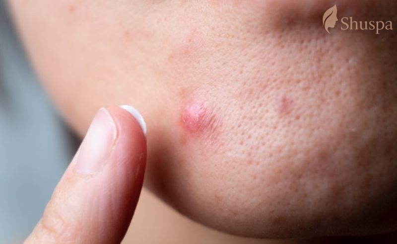 Vệ sinh và khử trùng là yếu tố quan trọng cần chú ý trước khi nặn mụn