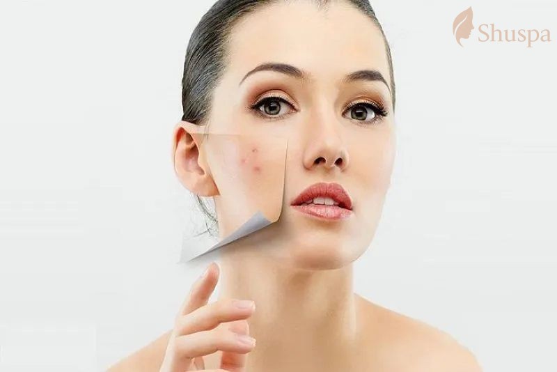 Dưỡng ẩm là chìa khóa giúp chăm sóc da sau nặn mụn cho bạn