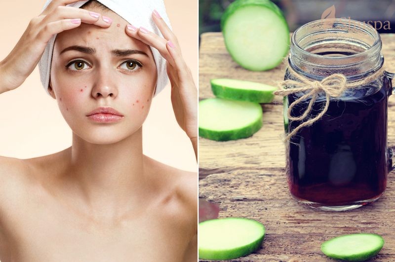 Cao bí đao trị mụn sẽ mang đến những kết quả khác nhau phụ thuộc vào tình trạng da