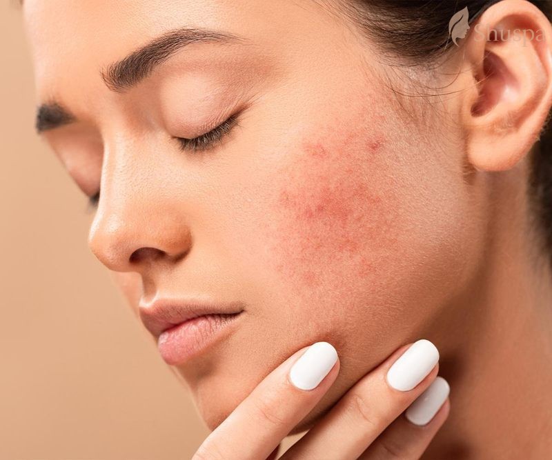 Những vấn đề thường gặp sau khi laser như bong tróc, khô da, mẩn đỏ