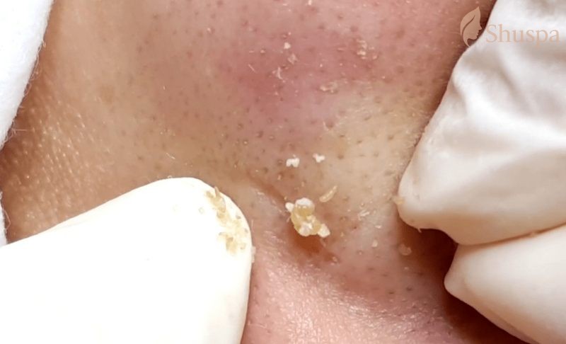 Cách nặn mụn bọc chai cứng hiệu quả mà bạn nên tham khảo