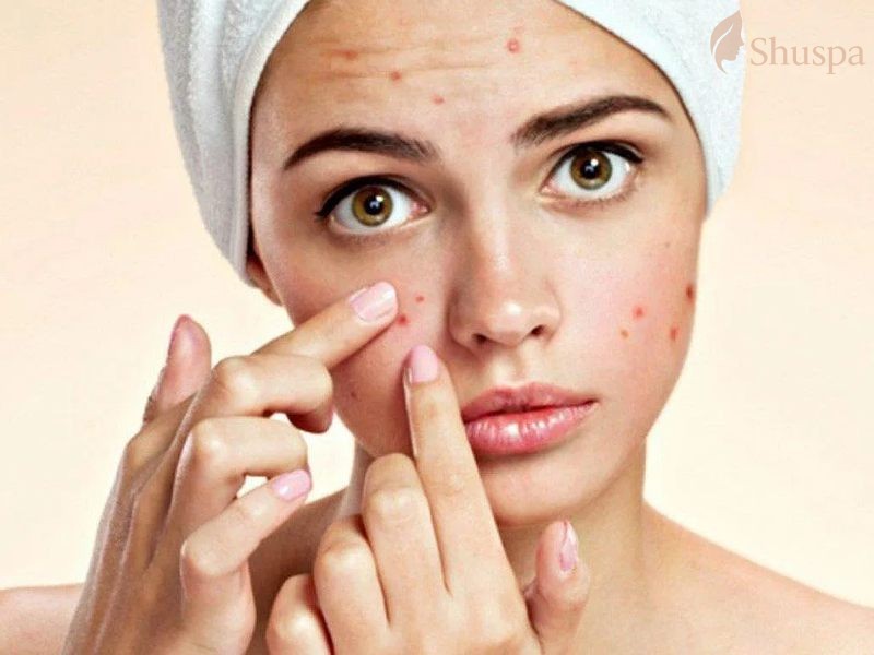 Những loại mỹ phẩm nên tránh sử dụng cho làn da sau nặn mụn