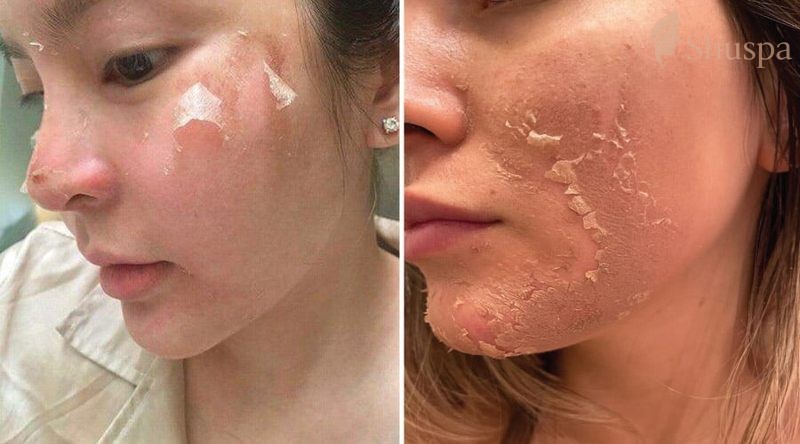 Xử lý tốt tình trạng bong tróc và khô da sẽ giúp làn da của bạn phục hồi nhanh hơn