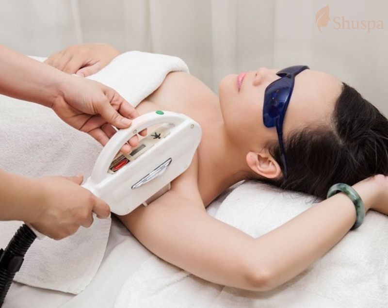 Số lần điều trị của triệt lông diode laser và khoảng cách giữa các lần