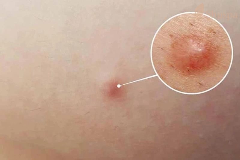 Tuỳ vào từng vùng da sẽ có cách nặn mụn bọc chai cứng khác nhau