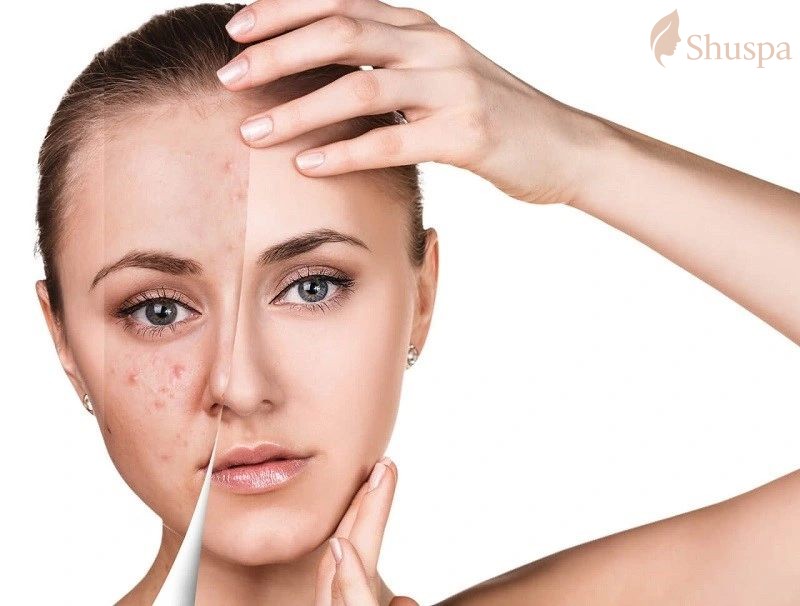 Phục hồi sẹo thâm sau nặn mụn cần có liệu trình chăm sóc và sản phẩm hỗ trợ phù hợp