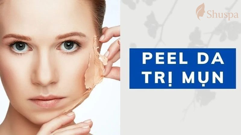 Một số cách peel da an toàn và hiệu quả khi điều trị mụn