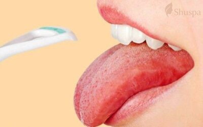 Những cách điều trị mụn ở lưỡi hiệu quả và đảm bảo an toàn