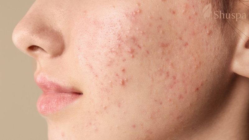 Sẹo lõm sau nặn mụn rất nguy hiểm cần có phương pháp điều trị chuyên biệt