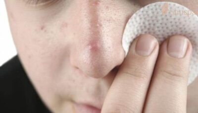 Điều trị mụn bọc bị chai cứng từ bên trong sẽ mang lại hiệu quả tốt hơn