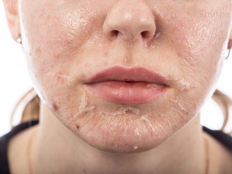 Những tác dụng phụ cần lưu ý khi peel da sinh học