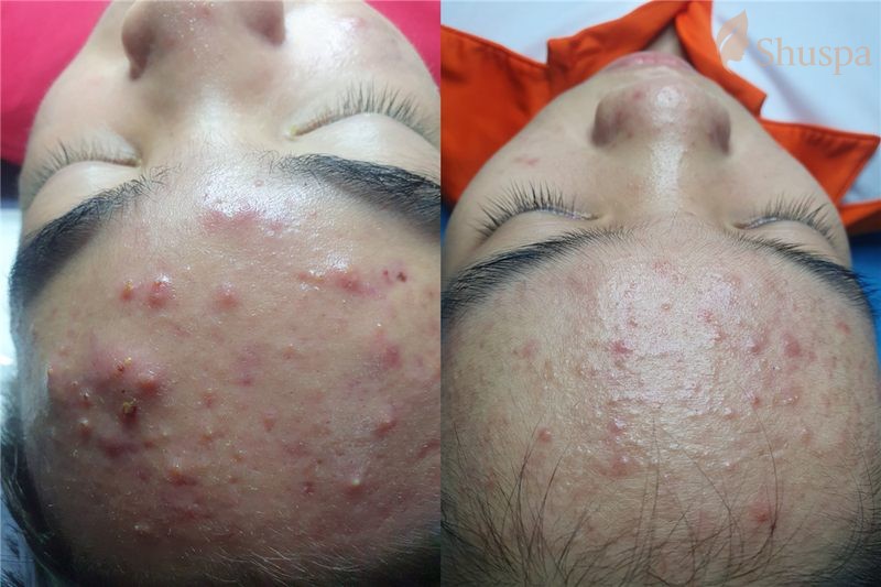 Những sai lầm tai hại trong chăm sóc da dầu mụn cần tránh xa