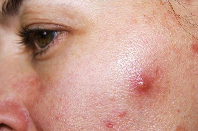 Phương pháp điều trị da chuyên nghiệp tại spa cũng sẽ làn da phục hồi tốt hơn