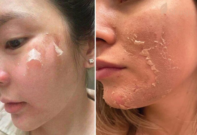 Những vấn đề cần lưu ý sau khi peel da
